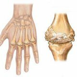 Reumatoidni artritis: metode liječenja