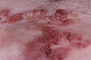 Signs of lymphangioma