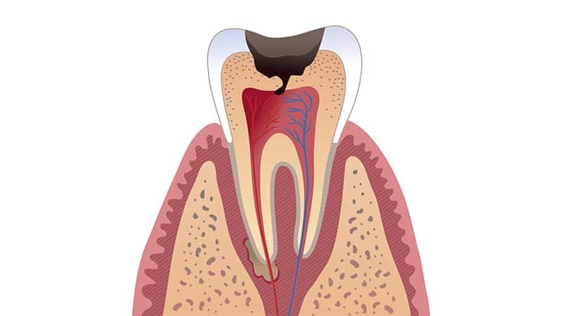 Geschwollenes Zahnfleisch zur Zahn