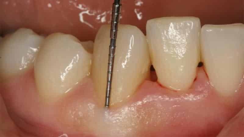 Pasta de dientes con periodontitis