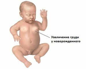 Baby gynecomastia