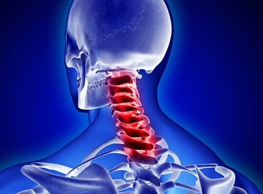 Behandlung von zerebrovaskulären Unfällen mit zervikaler Osteochondrose