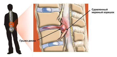 hondroprotektory-di-hernia-punggungan-vydguki pro-lykuvannya