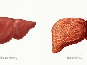 Alcoholic cirrhosis of the liver