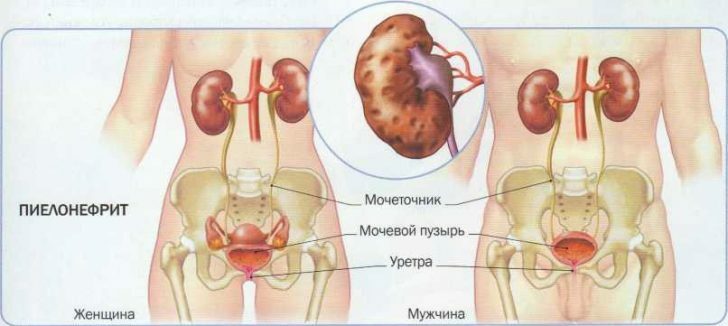 Pyelonephritis: symptomen, behandeling, vooral van de ziekte bij zwangere vrouwen en kinderen
