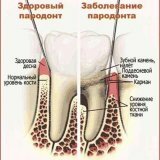 Folk Methoden der Behandlung von Parodontitis