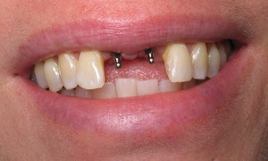 Lehetséges szövődmények és ellenjavallatok a fogászati ​​implantáció kifejezés implantátum, ellenjavallatok és mítoszok