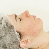 Behandeling van post-acne littekens