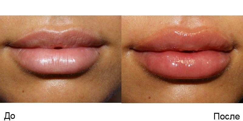 povečati zgornjo ustnico pred in po foto hialuronske kisline edem ustnic