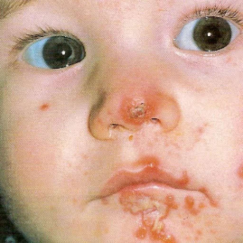 Streptodermie bei Kindern: Foto wie es beginnt, wie man es behandelt