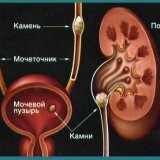 Urolitiāze: simptomi un ārstēšana