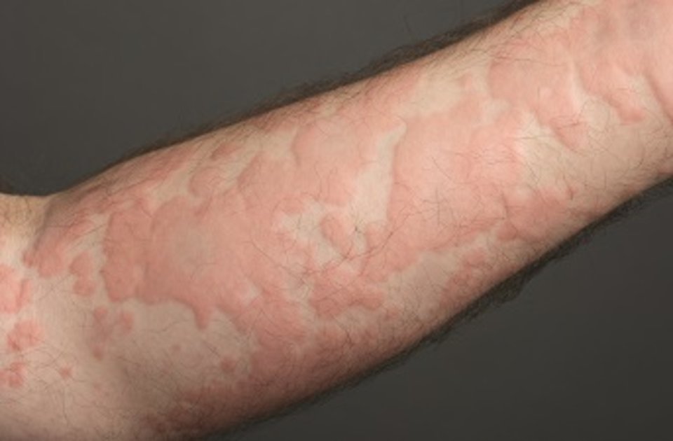 Urticarial rash: what is it, symptoms, causes, treatment