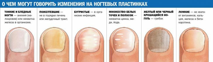 Tipične promjene vanjske noktiju