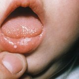 Méthodes populaires de traitement de la candidose stomatite