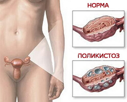 Polycystic ovary photo
