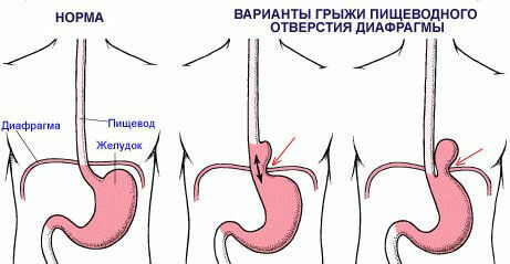 hernia diaphragmatica,