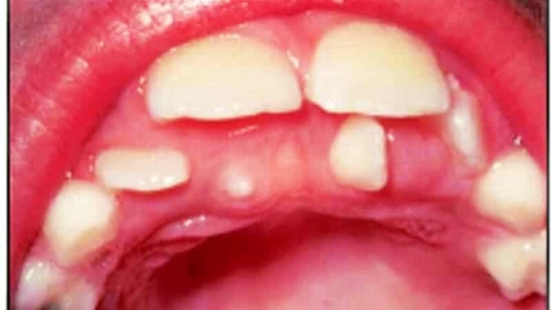 Les dents surnuméraires, des photos de l'enfant( giperdontiya)