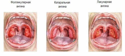 Bacterial tonsillitis: symptoms and treatment at home