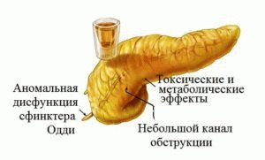 Alcoholische pancreatitis