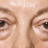 Edema under the eyes and kidney disease