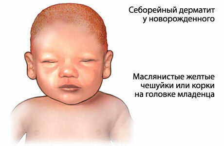 The reason for the appearance of crusts on the head of a baby
