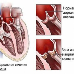 The main causes, symptoms and treatment of endocarditis