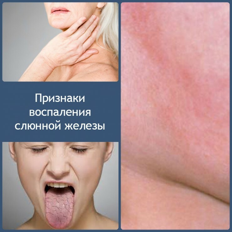 Signs-inflammation-salivary gland-740x740