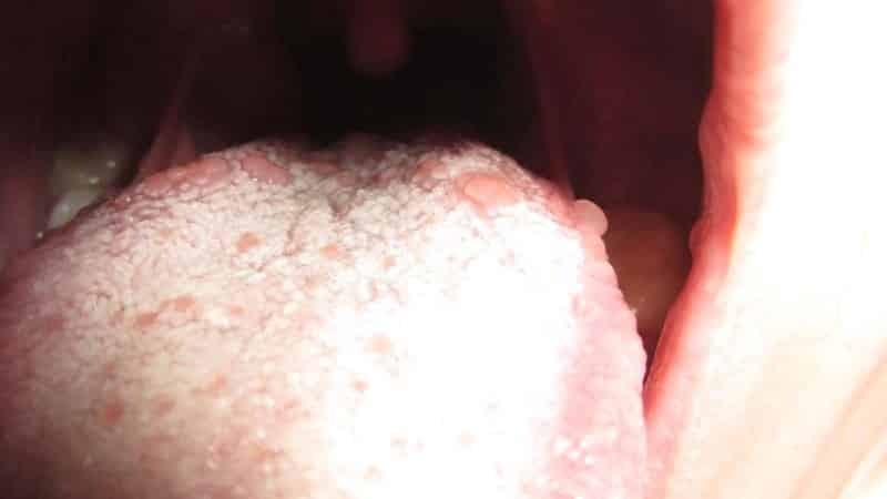Vesciche sulla lingua del bambino: una foto di vesciche sulla radice della lingua