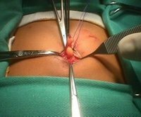 Removal of umbilical hernia