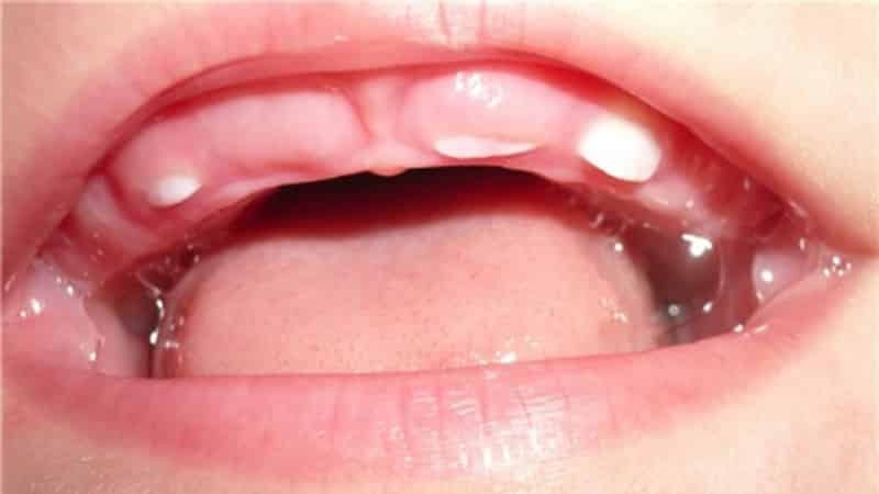 Comment sont les gencives lorsque la dentition