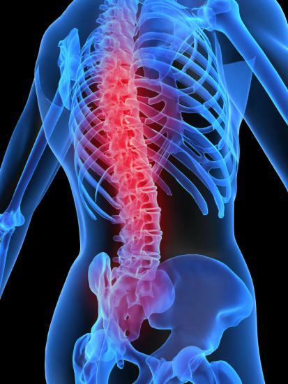 Homogentisuria puede afectar negativamente a la condición de la columna vertebral