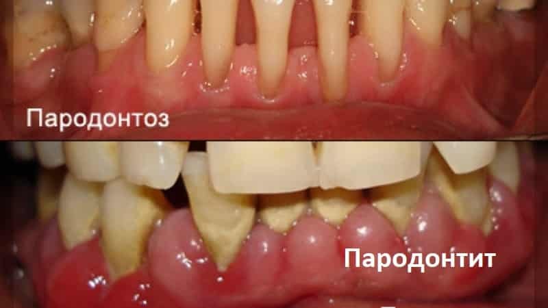 skillnaden mellan periodontit genom periodontal sjukdom