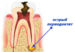 Acute parodontitis