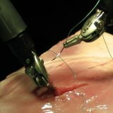 Suture materials for surgery