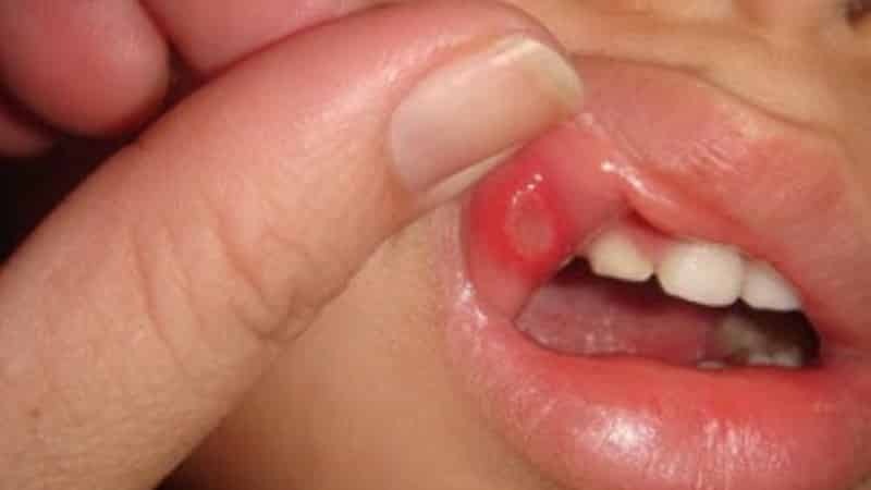stomatitis aftosa pada anak-anak diperlakukan