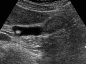 cholelithiasis
