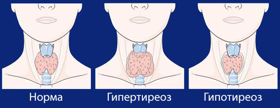Thyroid gland diseases and their symptoms