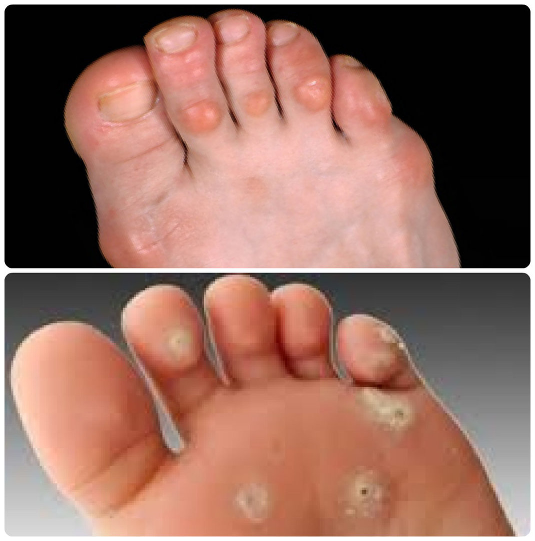 Colisão no dedo mínimo do pé, o que se osso cresce no pé perto do dedo mínimo