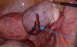 Ruptura cervikalnih jajnika