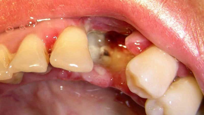 tandutdragning hur långt hål läker