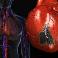 Atypiske former for hjerteinfarkt