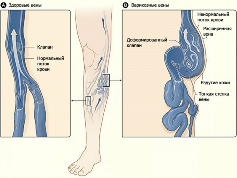 54829-thrombus-and-treatment-in-Kemerovo