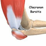 Treatment of bursitis in the elbow joint