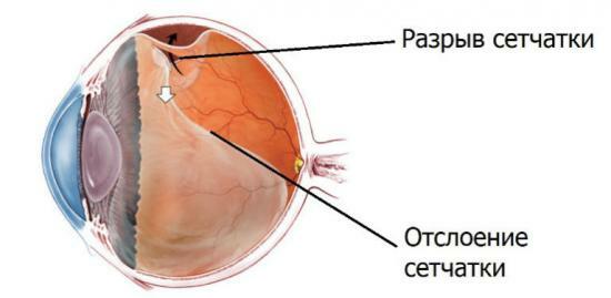 znaci odvajanje mrežnice očiju