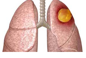 Abscess of the lung: symptoms and treatment