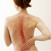 Skolióza hrudnej chrbtice