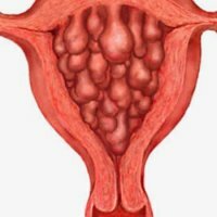 Atypische endometriale hyperplasie