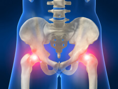Osteoporosis imágenes