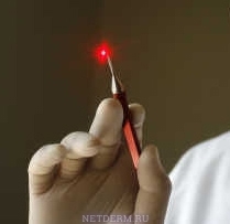 Odstránenie krtkov pomocou laserového noža