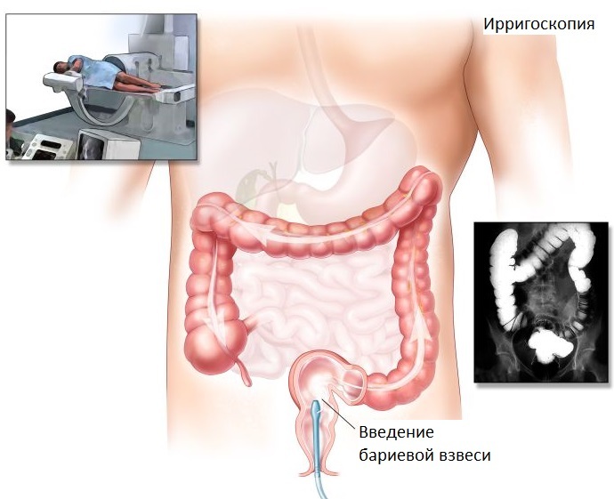 O tratamento-cancro de grande-intestino-1